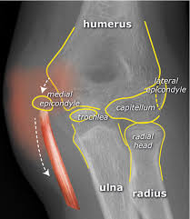 Posterior elbow dislocation transmitting force to the medial epicondyle via the ulnar collateral ligament (most common; Startradiology