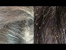 head lice or dandruff