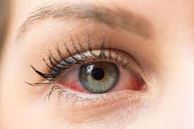 red eyes allergies or coronavirus