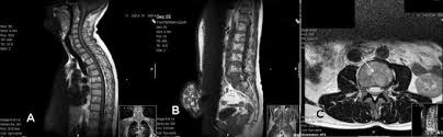 myxoid liposarcoma detected by mri