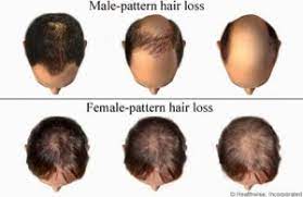 Intense itching on hands, legs and scalp. Hair Loss In Men And Women Diagnosis And Treatment Options Carefirst Specialty Pharmacy S Blog