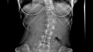 • interconnects and crossbars • arbitration, replication, qos, speedup, resiliency. Scoliosis Treatment Symptoms And Causes