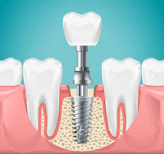 9,531 Dental Implant Illustrations & Clip Art - iStock
