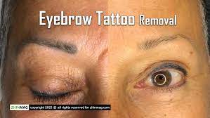 eyebrow tattoo removal 8 very