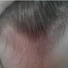 what happens if i stop using minoxidil