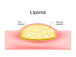 lipoma skin and fatty tissue tumors