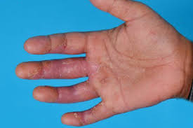 hand eczema causes symptoms and treatment