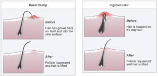 prevent ingrown hairs after shaving