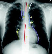 You have completed this module. Normal Chest X Ray Terminology And Radiographic Anatomy Springerlink
