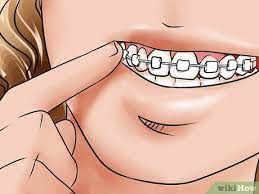 Menu ask a question share a post account search. How To Apply Dental Wax On Braces 12 Steps With Pictures