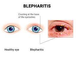 blepharitis treatments in nyc best
