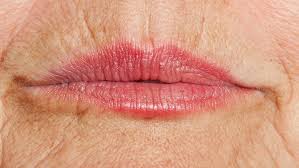 lip lines allura skin laser