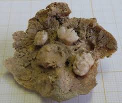 ovarian teratoma with teeth discovered