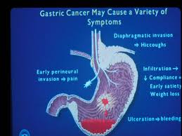 Your symptoms are unlikely to be cancer but it is important to get them checked by a doctor. Gastric Cancer Cancer Therapy Advisor