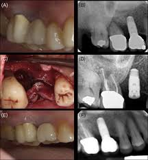 You must eat soft foods for two to three days after the root canal treatment. Root Canal Treatment Versus Single Tooth Implant Sciencedirect