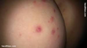 But if you look close you can see the tiny white spots. Buttock Boils Herpes And Fungal Infections Treatment Healthise Com