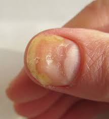 nail fungus richmond dermatology