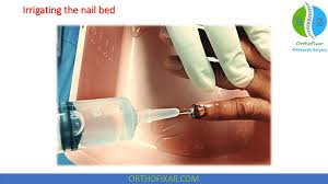 nail bed repair 2023 orthofixar