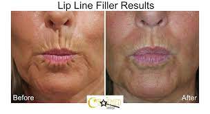 lip and smoker lines improvement with