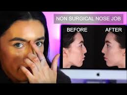non surgical nose job liverpool