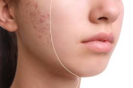 home remes for cystic acne