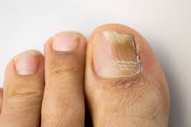 types ses of toenail fungus