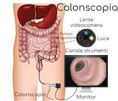 Essa interessa il colon e l'intestino tenue con alterazioni delle funzioni motorie, della sensibilità dolorosa e della secrezione di liquidi. Colonscopia Preparazione Procedura Dolore