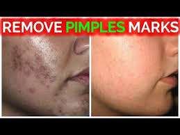 remove pimple marks acne marks dark