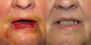 lip reconstruction gallery skin
