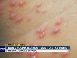 Vaccines and Managing With Chicken Pox