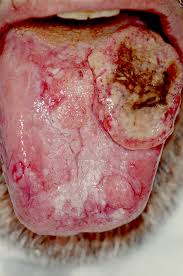 Abnormal cell growth usually appears as flat patches. Head And Neck Cancer Wikipedia