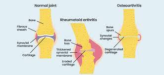 National Rheumatoid Arthritis Society gambar png