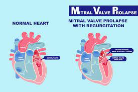 2019 the valve, which is the size of a dime, allows doctors to treat babies in need of a mitral or aortic valve replacement, according to abbott laboratories, the. What You Need To Know About Mitral Valve Prolapse