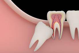 6 symptoms of impacted wisdom teeth