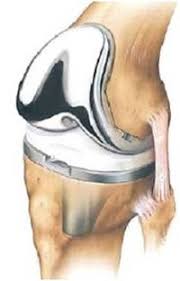 total knee arthroplasty physiopedia