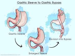16 revision bariatric surgery in mexico