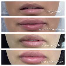 how long do lip fillers last top
