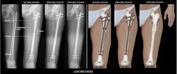 limb lengthening surgery