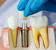 Qual o material usado em implantes dentários? Leia mais!