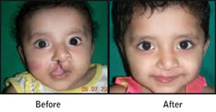 free cleft lip palate surgery at