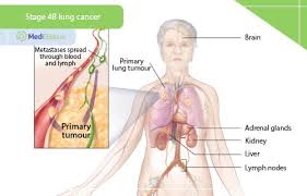 can se 4 lung cancer be cured