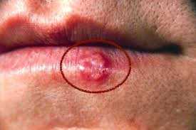 swollen lips 10 common causes what