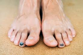 black toenail symptoms causes and