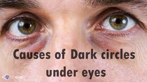 causes of dark circles under eyes