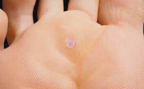 plantar wart removal how to remove