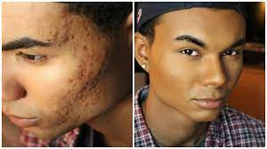 acne scarring coverage