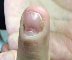 painless deformity of a fingernail mpr