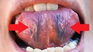 舌头下长青筋，是身体发生了哪些变化？看完要当心了