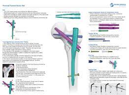 proximal fem bionic nail cal