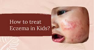 how to treat eczema in kids es